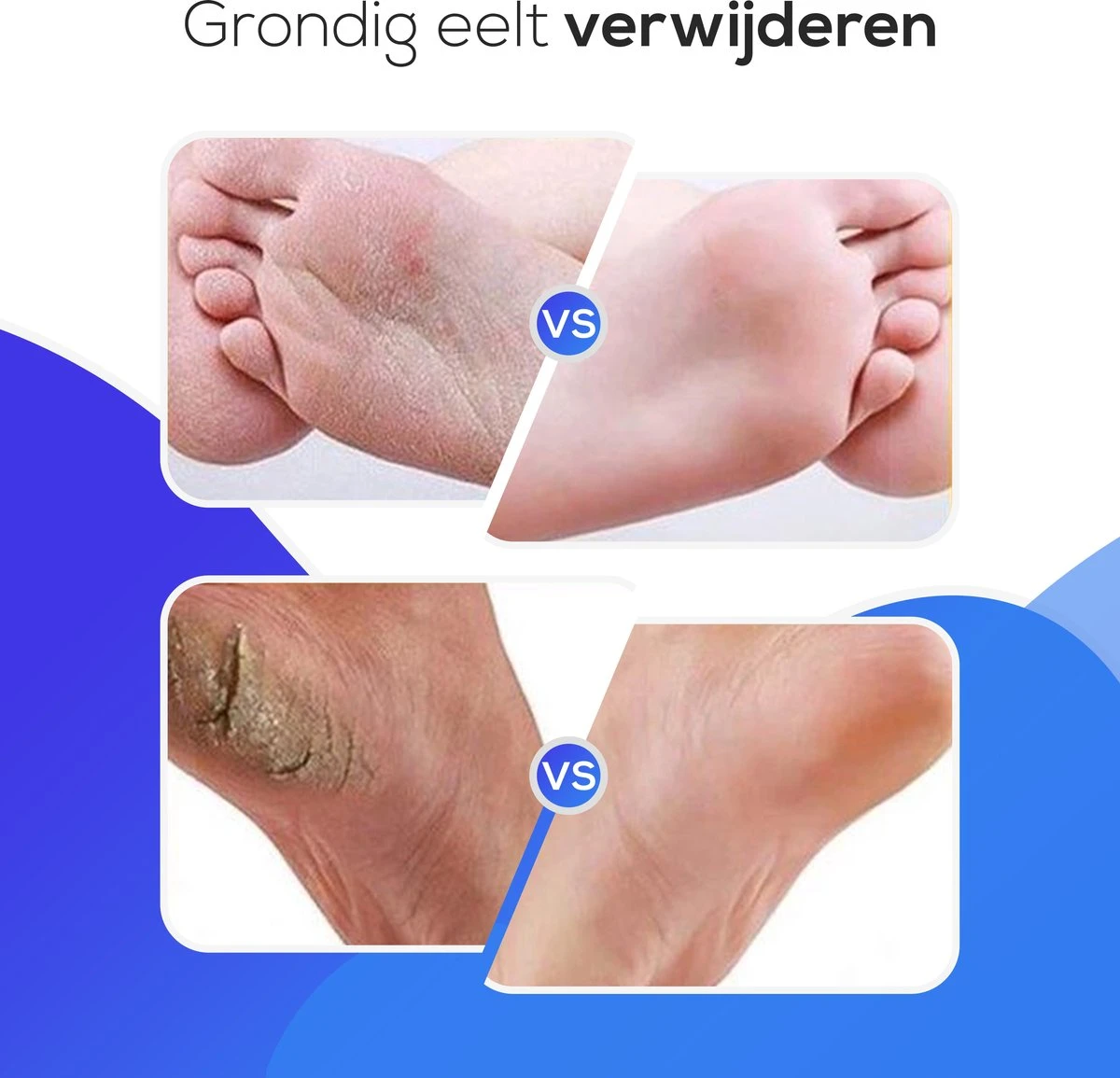 LifeWise Elektrische Eelt Verwijderaar - Voetvijl - 60 Vervangbare Schuurpads - Netstroom Adapter 9 LifeWise Elektrische Eelt Verwijderaar - Voetvijl - 60 Vervangbare Schuurpads - Netstroom Adapter - Image 9