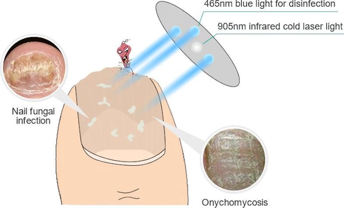 Anti Schimmelnagel Kalknagel Laserapparaat Om Zelf Te Behandelen, Veilig, Effectief, Snel En Pijnloos, Koude Laser Behandeling Voor Thuisgebruik, Voor Tenen En Vingers. Oplaadbaar. 2 Anti Schimmelnagel Kalknagel Laserapparaat Om Zelf Te Behandelen, Veilig, Effectief, Snel En Pijnloos, Koude Laser Behandeling Voor Thuisgebruik, Voor Tenen En Vingers. Oplaadbaar. - Image 2