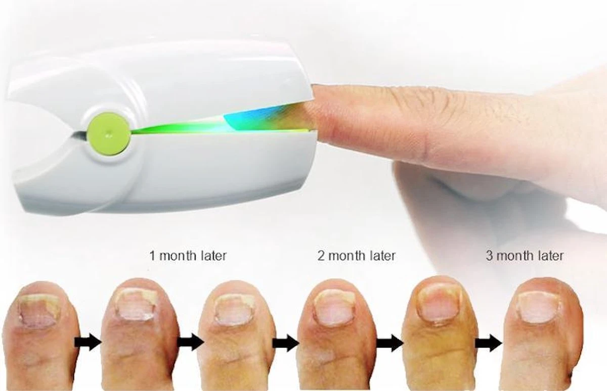 Anti Schimmelnagel Kalknagel Laserapparaat Om Zelf Te Behandelen, Veilig, Effectief, Snel En Pijnloos, Koude Laser Behandeling Voor Thuisgebruik, Voor Tenen En Vingers. Oplaadbaar. 3 Anti Schimmelnagel Kalknagel Laserapparaat Om Zelf Te Behandelen, Veilig, Effectief, Snel En Pijnloos, Koude Laser Behandeling Voor Thuisgebruik, Voor Tenen En Vingers. Oplaadbaar. - Image 3